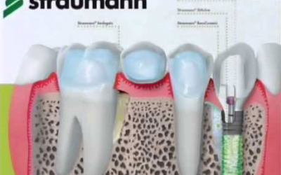 Qual o melhor implante dentário?