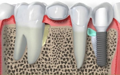 Implante dentário nacional x implante importado: vale a pena usar um implante importado?