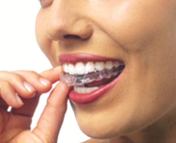 Nova técnica em Tratamento Ortodôntico possibilita Alinhamento dos dentes  mais rápido e com menos consultas