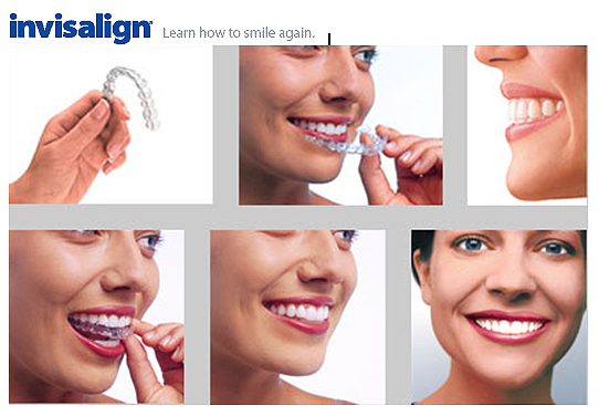 A Invisalign® arrumou briga no Brasil – Como funciona a Invisalign® para o  dentista/ortodontista americano? – Revalida USA