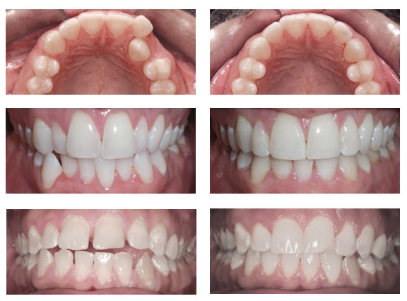 Avaliação comparativa do alinhador dentário transparente versus aparelho  fixo para retração anterior: um estudo de elementos finitos